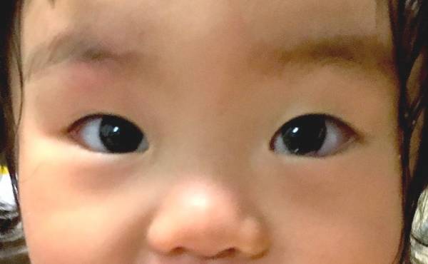 生後1カ月、いちご状血管腫が。「様子を見ましょう」と言われたけど…