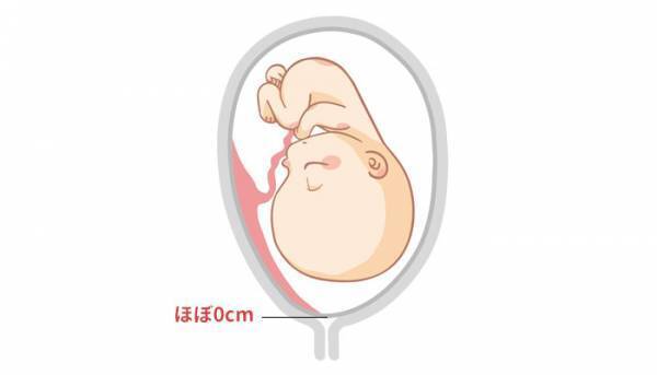 胎盤と内子宮口との距離が2.4cm！どうしたらいい？【助産師に相談】