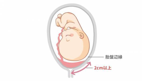 胎盤と内子宮口との距離が2.4cm！どうしたらいい？【助産師に相談】
