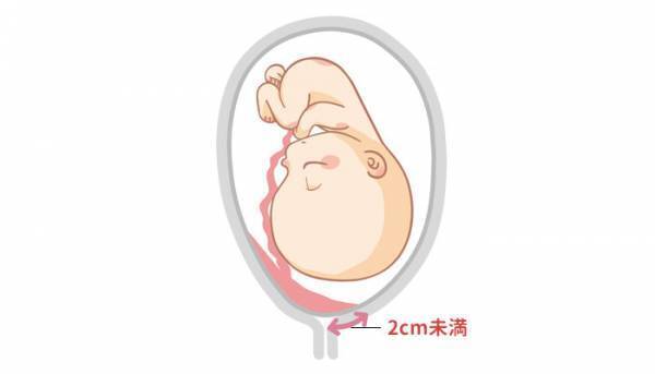 胎盤と内子宮口との距離が2.4cm！どうしたらいい？【助産師に相談】
