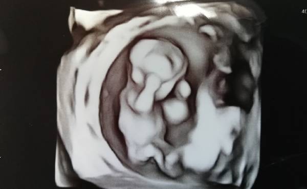 「染色体異常の可能性があります」医師の言葉にショックを隠しきれず…