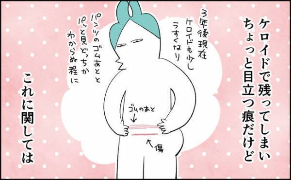 帝王切開の傷をどう思うか？問題【んぎぃちゃんカレンダー141】