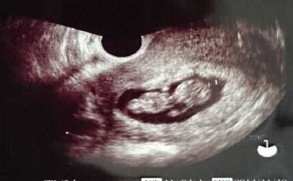 おなかの中のベビーに病気が見つかった…【ママの体験談】