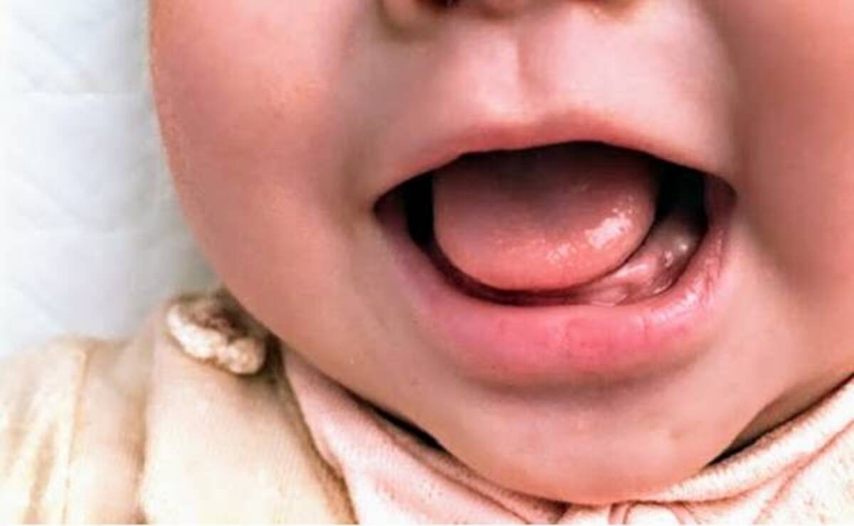 え 何これ 赤ちゃんの歯茎に小さな白いブツブツが 体験談 年5月15日 ウーマンエキサイト