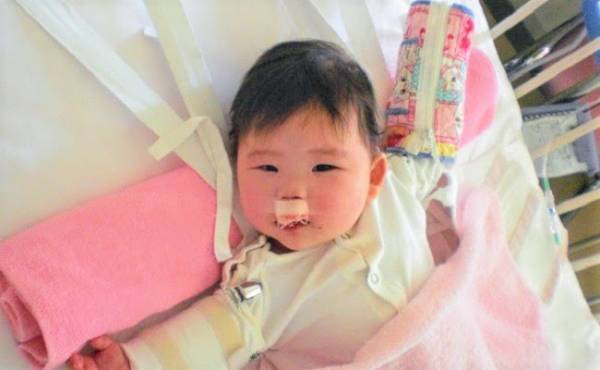 口唇口蓋裂の治療ってどんなことをするの！？【1回目の手術編】