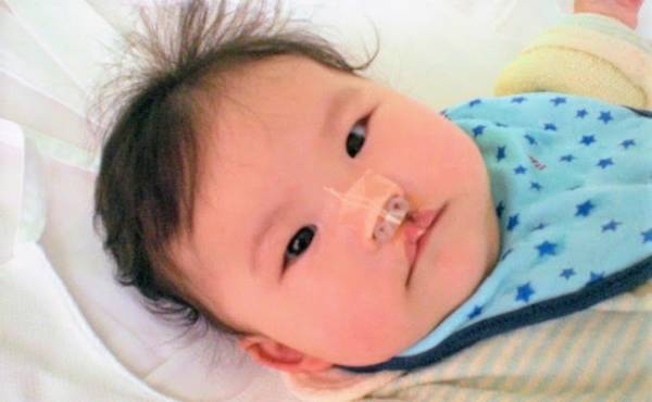 口唇口蓋裂の治療ってどんなことをするの！？【1回目の手術編】