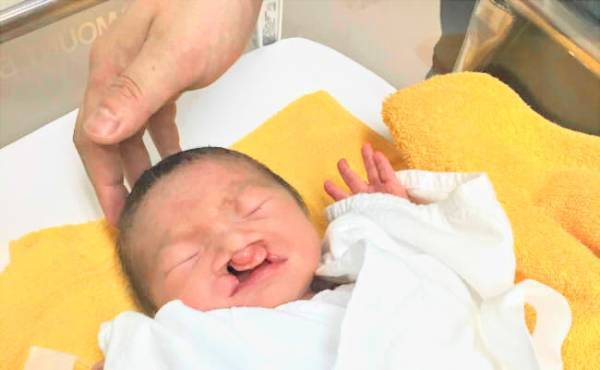 出産中、赤ちゃんが「口唇口蓋裂」とわかった。初めて見たとき、夫は…？