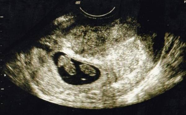 三度目の妊娠でまさかの「三つ子」だった！？ 不安と喜びの妊娠体験談