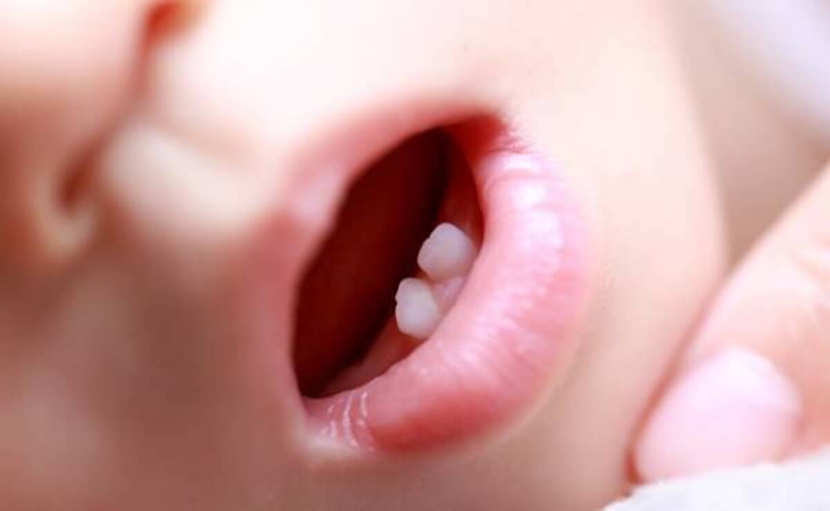 1歳すぎ 前歯の間に得体の知れない歯が 歯医者さんで相談してみたら 年11月4日 ウーマンエキサイト 1 2