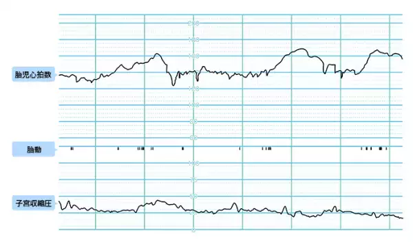 おなかが張るたびに心拍が低下！ 陣痛が来たときが心配だけど大丈夫？