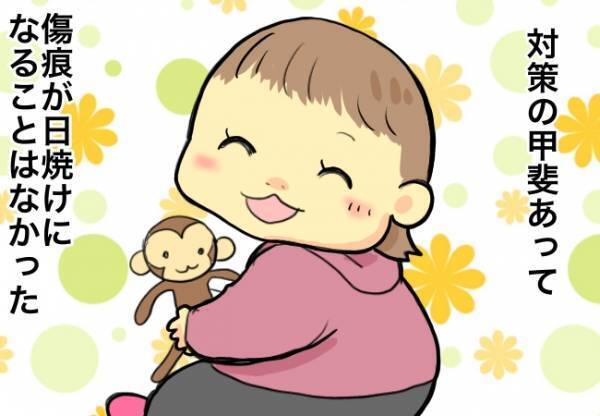 術後の生活で特に気を付けたこと【口唇口蓋裂ちゃん、育ててます108】