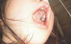 生まれつき鼻の下と口蓋に裂が…娘がおこなった歯科矯正【体験談】