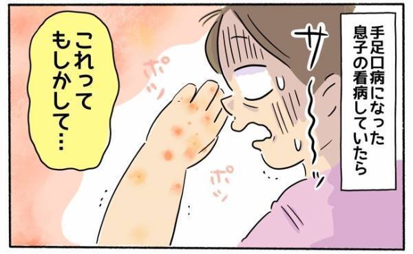 重症化するって本当！？ 子どもの「手足口病」が大人にうつってしまい…
