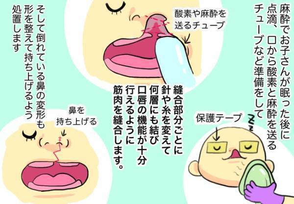 唇を縫合、鼻を持ち上げる？！【口唇口蓋裂ちゃん、育ててます79】