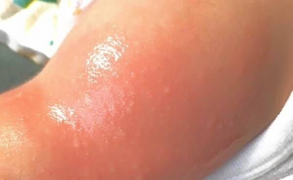 えっ まさか 洗わなかったせい 予想外だったアレルギー症状の原因 年4月4日 ウーマンエキサイト 1 2