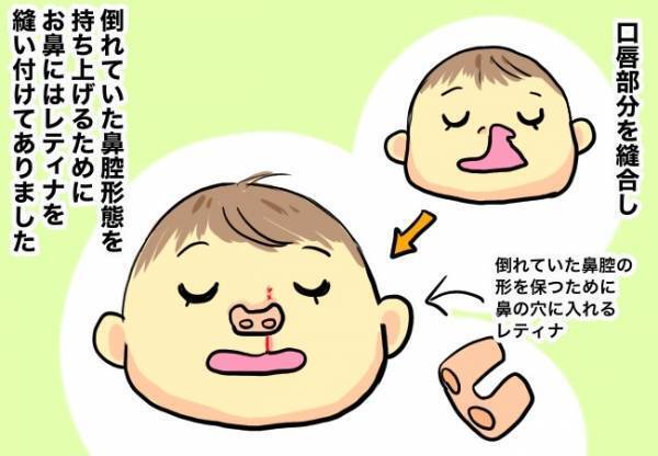 手術後の注意、手術を終えた夜。【口唇口蓋裂ちゃん、育ててます93】