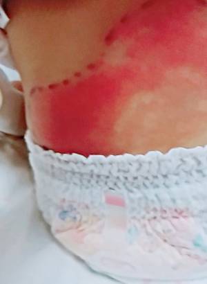 え、入院！？ 娘の腰に赤いできもの。ただのおむつかぶれと思ったら…