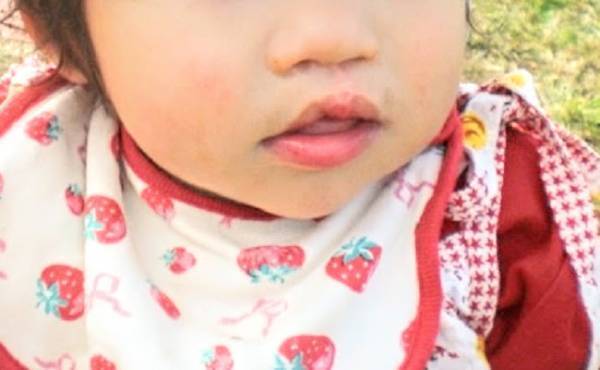 口唇口蓋裂で生まれた娘のこれから。就学後の治療について【ママの体験談】