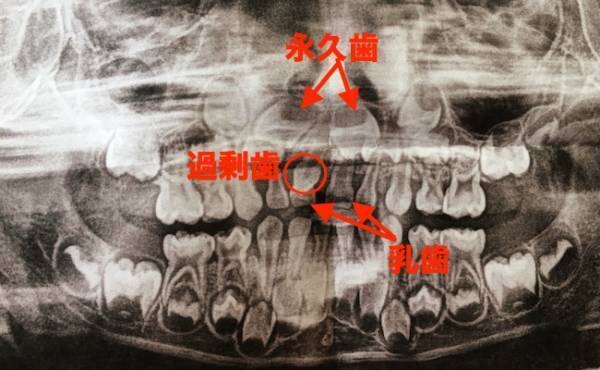 4歳で歯が抜けそう？歯科医から予想もしていなかった診断が…【体験談】