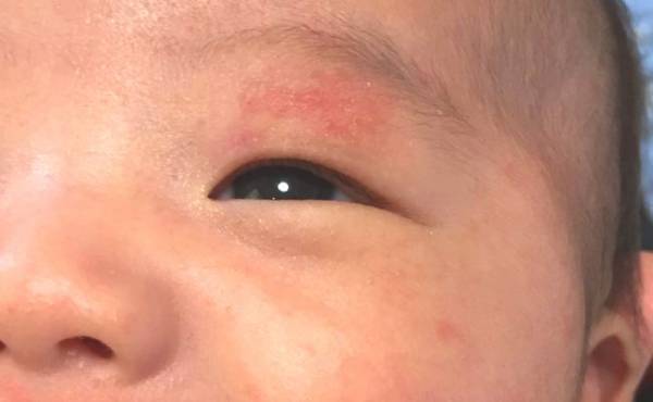 出産翌日、赤ちゃんのあざに気づきショック…！生後3カ月でレーザー治療を受けて