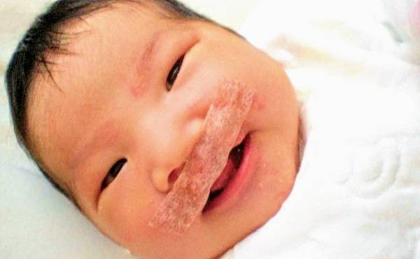 口唇口蓋裂で生まれた娘の将来が不安…私を救ってくれたのは娘の笑顔でした【体験談】