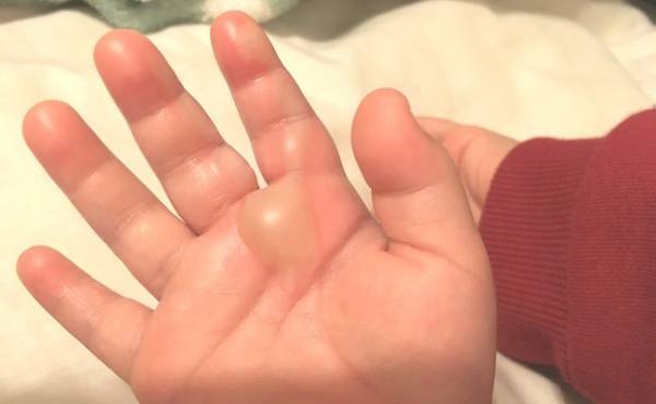 「まさか！」血の気が引いた…生後11カ月で手に大やけどを負って【体験談】