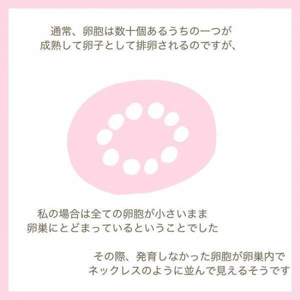 「多嚢胞性卵巣症候群って？」長年の謎は解けたけれど…妊娠できるの！？