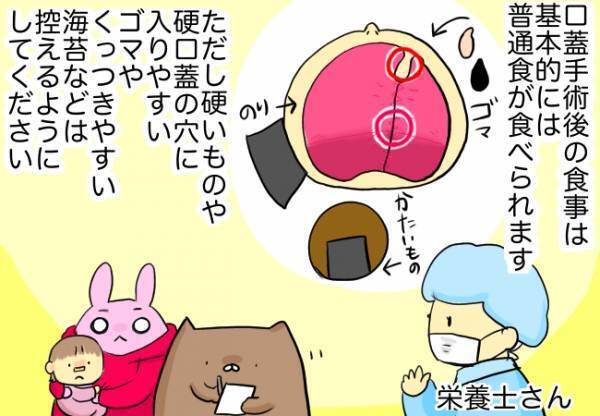 口蓋手術後の食生活の注意点とは？日常生活で気を付けていたこと
