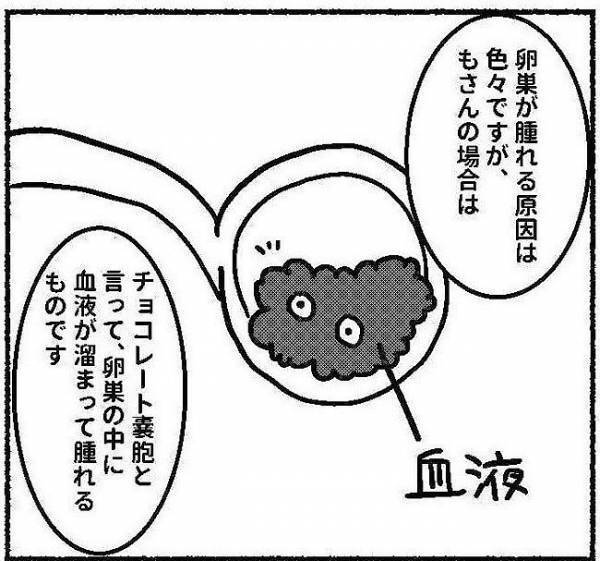 卵巣の腫れ、原因はチョコレート嚢胞だった！手術は必要……！？ #子宮内膜症日記 8