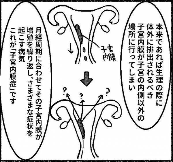「自然治癒はない...」選択肢は2つ…！ #子宮内膜症日記 9