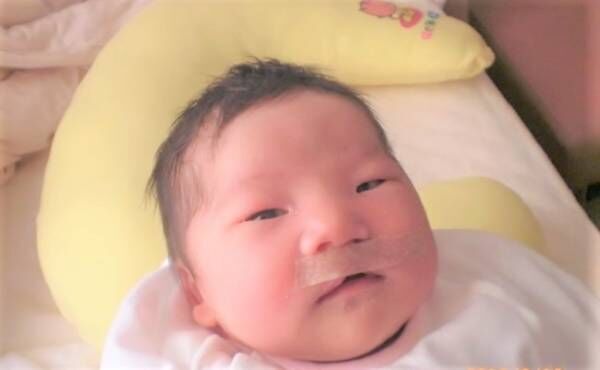 口唇口蓋裂って何 治るの 先天異常を持った娘の症状と治療 前編 21年1月21日 ウーマンエキサイト 1 2