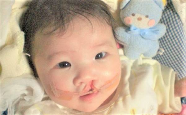 口唇口蓋裂って何！？治るの…？先天異常を持った娘の症状と治療【前編】