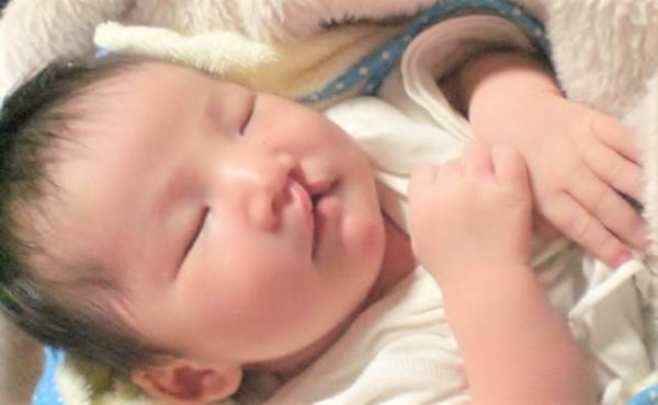 口唇口蓋裂って何！？治るの…？先天異常を持った娘の症状と治療【前編】