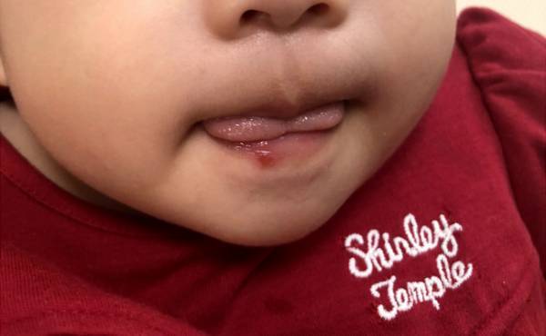 生後7カ月、唇にできもの。「まさか口唇ヘルペス？」と思いきや正体は…