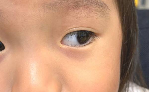 出産翌日、赤ちゃんのあざに気づきショック…！生後3カ月でレーザー治療を受けて