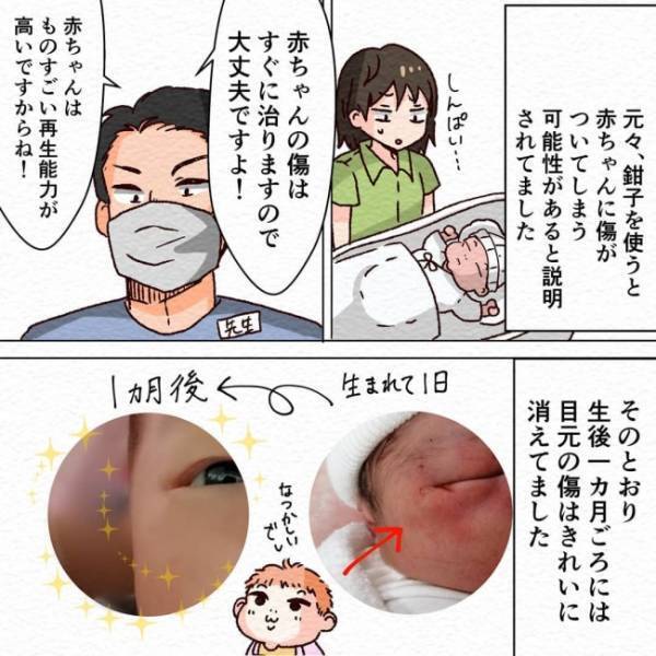 「心配。赤ちゃんの顔にキズが…！」しかし1カ月後に確認すると、先生の言った通りで… #無痛分娩 最終話