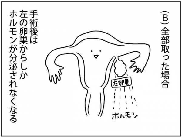 究極の2択！？卵巣嚢腫の手術法を選ぶ際の決め手は… #卵巣ボーダーライン 6