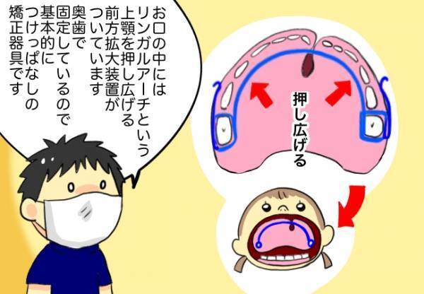 想像していた物と全然違った矯正器具！しかし、その機能性は抜群だった！