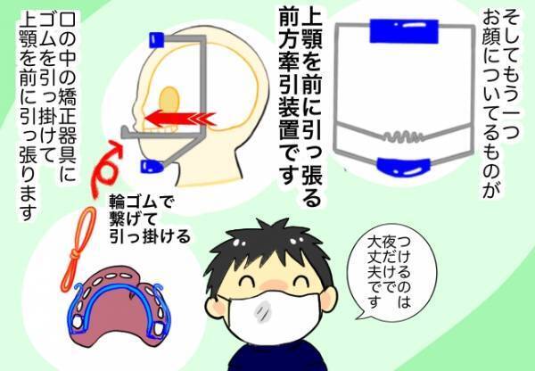 想像していた物と全然違った矯正器具！しかし、その機能性は抜群だった！