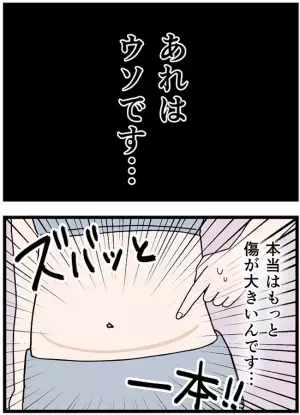 ＜卵巣が巨大化！？＞「突然ですが告白します」おなかにできた消えない傷。そのワケは…