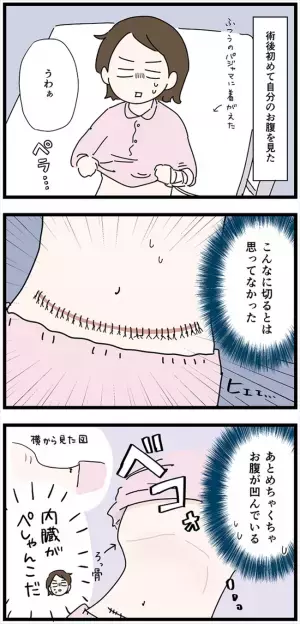 ＜卵巣が巨大化！？＞「何これ！キモい！」術後のおなかの様子をよ〜く見てみたら…