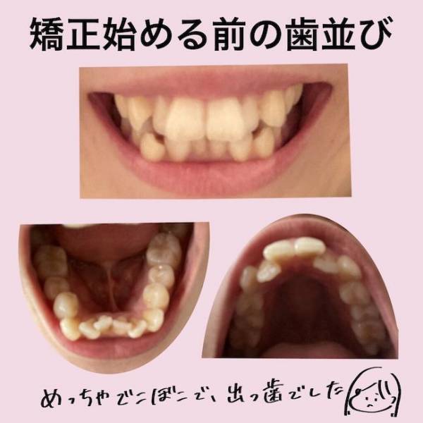 ＜歯列矯正＞「人前で笑えない…」でこぼこ歯並びどうすればいい？