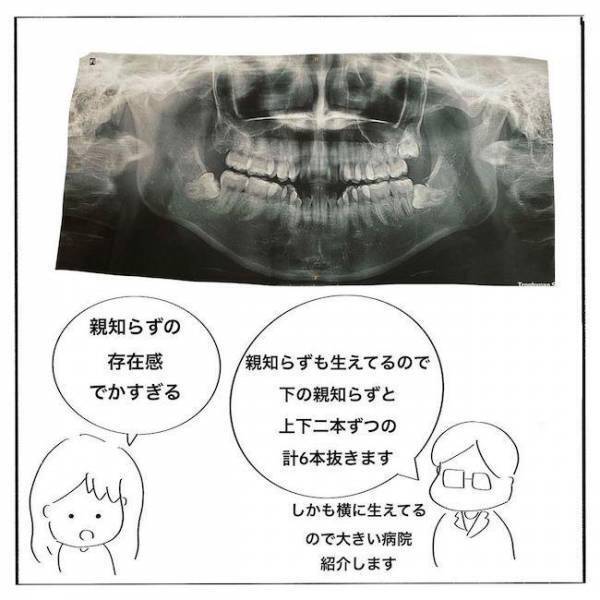 ＜歯列矯正＞「そ、そんなに抜くの…？！」外科手術が必要な理由は？