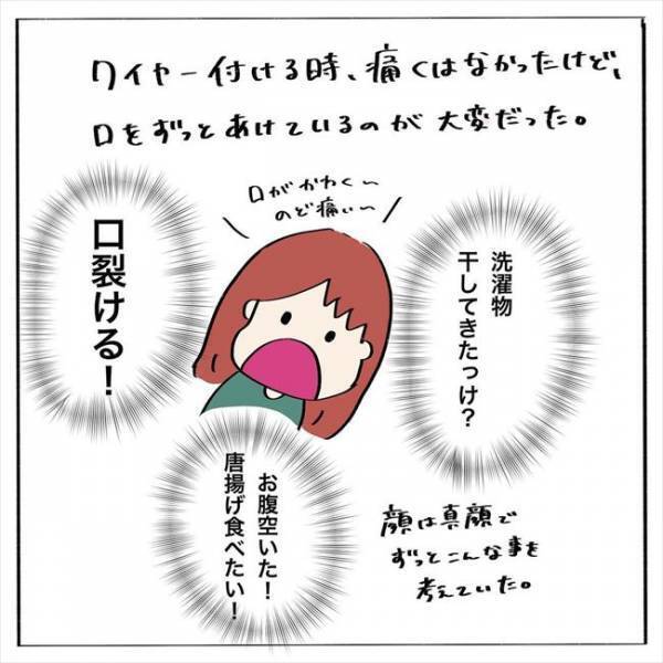 ＜歯列矯正＞「これぞ矯正…！」ついにワイヤー装着。気になる装着感は…？