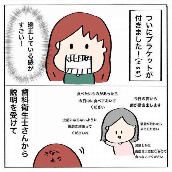 ＜歯列矯正＞「これぞ矯正…！」ついにワイヤー装着。気になる装着感は…？