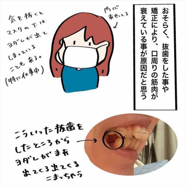 ＜歯列矯正＞「止まらないよぉ…」気づくとびちゃびちゃ。これって矯正あるある？