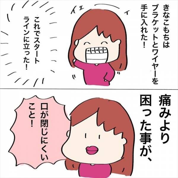 「私って、フグゴリラ…？！」矯正装置をつけたら思わぬ悩みに直面！ #歯列矯正はじめました 14