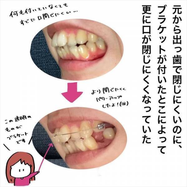 ＜歯列矯正＞「私って、フグゴリラ…？！」矯正装置をつけたら思わぬ悩みに直面！