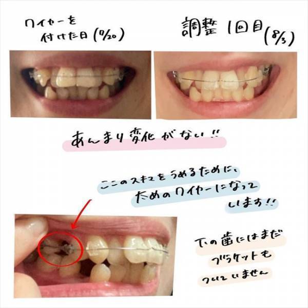 ＜歯列矯正＞「ぎゃぁあ〜！」はじめてのワイヤー調整日。未体験の痛みに思わず…