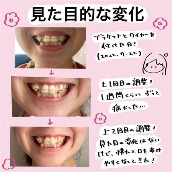 ＜歯列矯正＞「ぎゃあぁぁ！」唐揚げで悶絶！聞いてはいたけどこんなに痛いの？！
